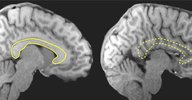 brain imaging