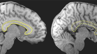 brain imaging