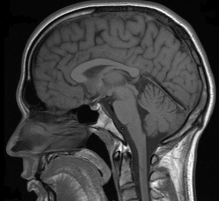 An MRI scan of the head.