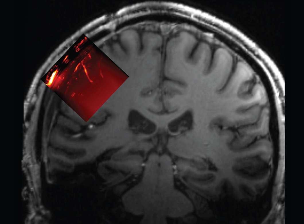Drawing of human head from the back showing outline of skull, with a red rectangle on the left showing the area of the brain that can be imaged with ultrasound.