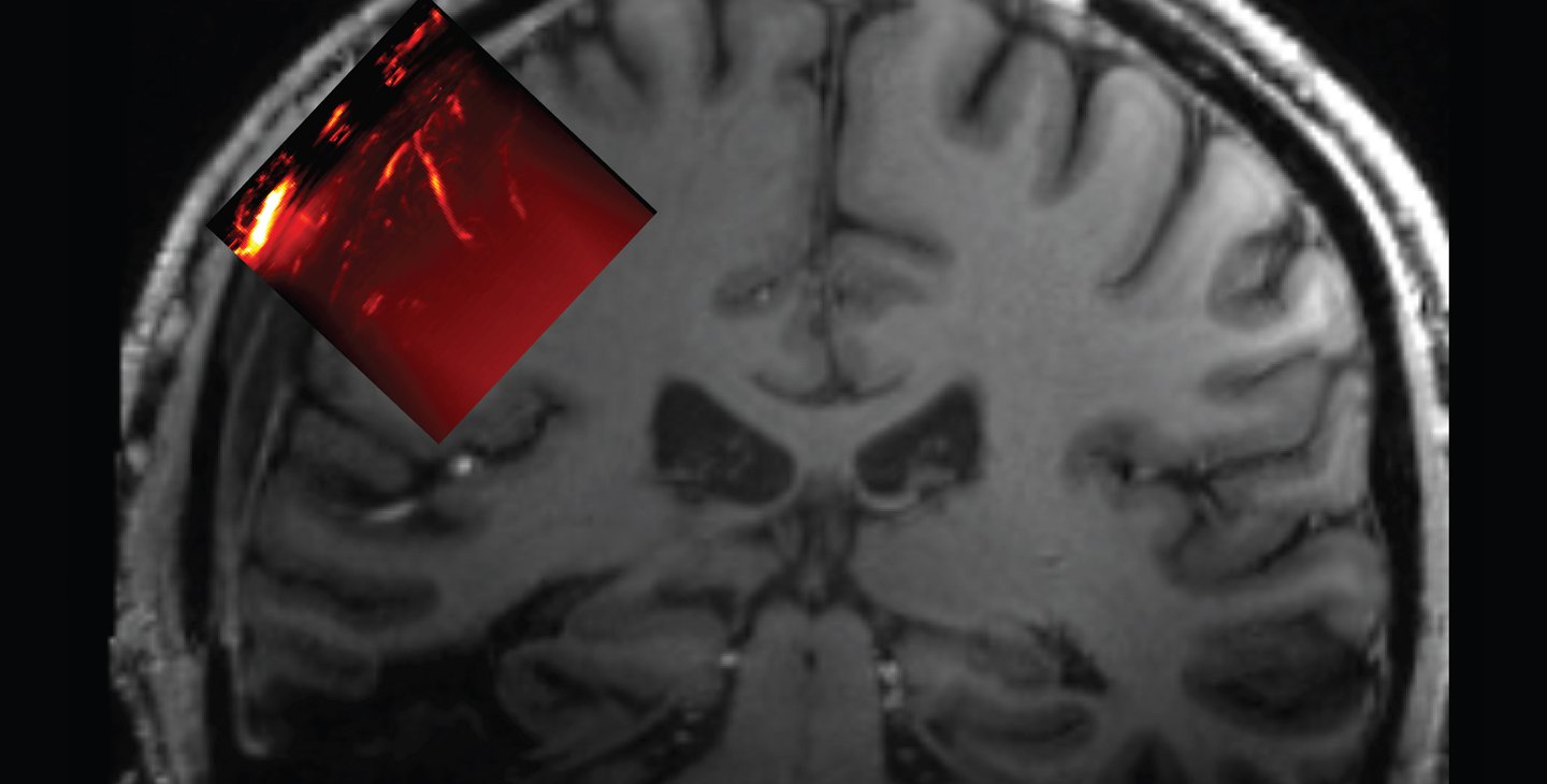 Drawing of human head from the back showing outline of skull, with a red rectangle on the left showing the area of the brain that can be imaged with ultrasound.